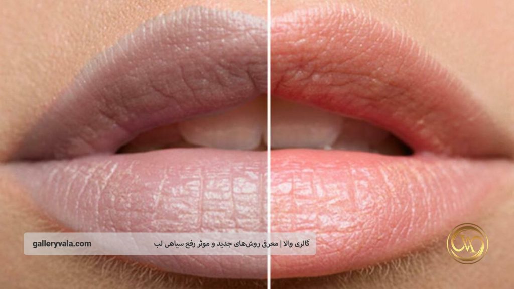 دلایل تیرگی لب‌ها | گالری والا